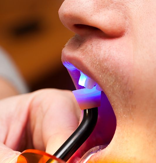 Patient receiving dental bonding treatment