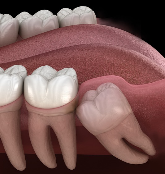 Animated smile with an impacted wisdom tooth before extraction