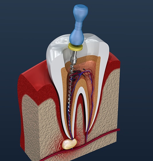 Animaed root canal therapy process