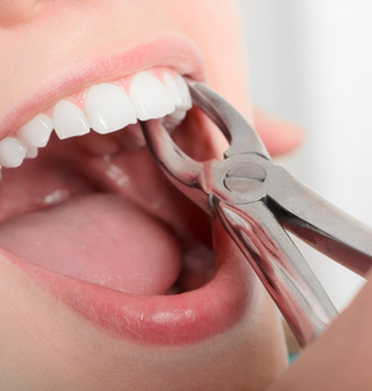A dentist using forceps to extract a woman’s tooth