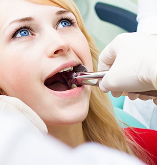 Factors that Can affect the cost of tooth extraction include the location of tooth within the mouth