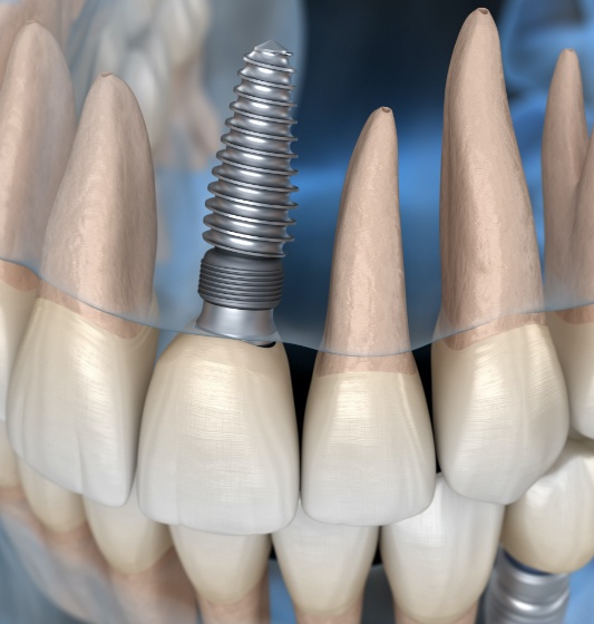 Animated dental implant supported dental crown