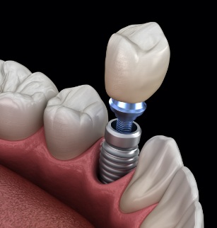 Animated dental implant supported dental crown placement