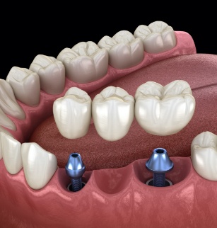 Animated dental implant supported fixed bridge placement