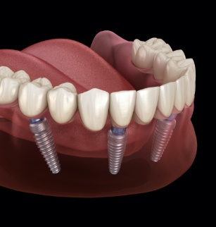 Animated dental implant supported denture placement