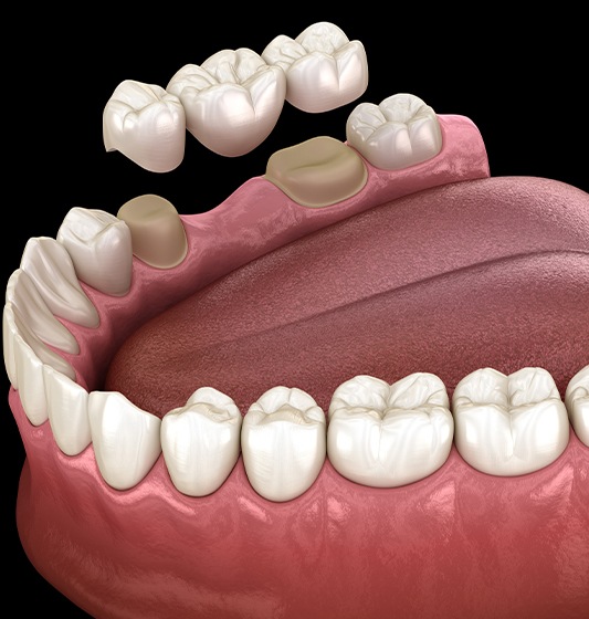 Animated dental bridge positioned to replace missing teeth