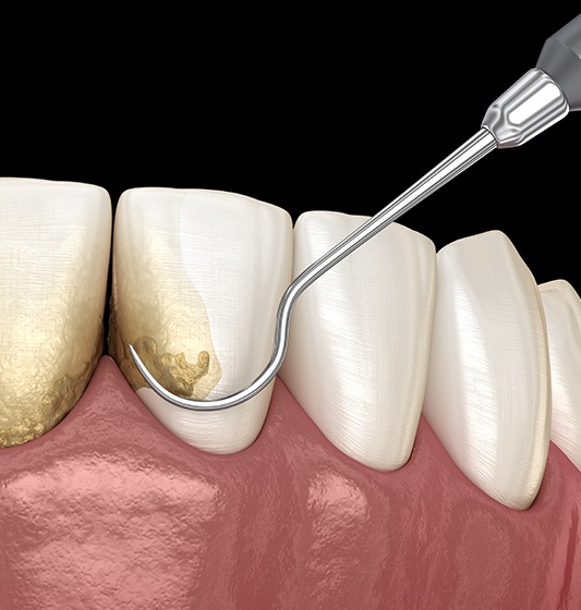 Animated smile during scaling and root planing periodontal therapy