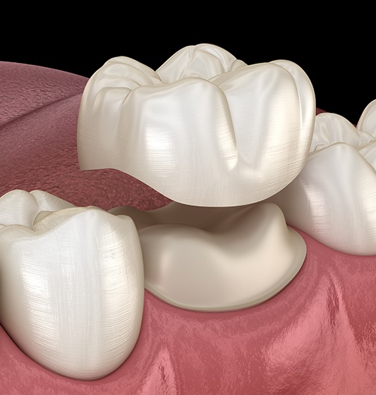 Animated dental crown restorative dentistry treatment