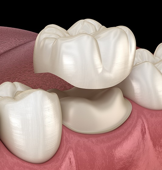 Animated dental crown restorative dentistry treatment