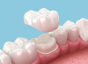 a digital image of a dental crown